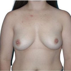 Breast Augmentation Before & After Patient #726