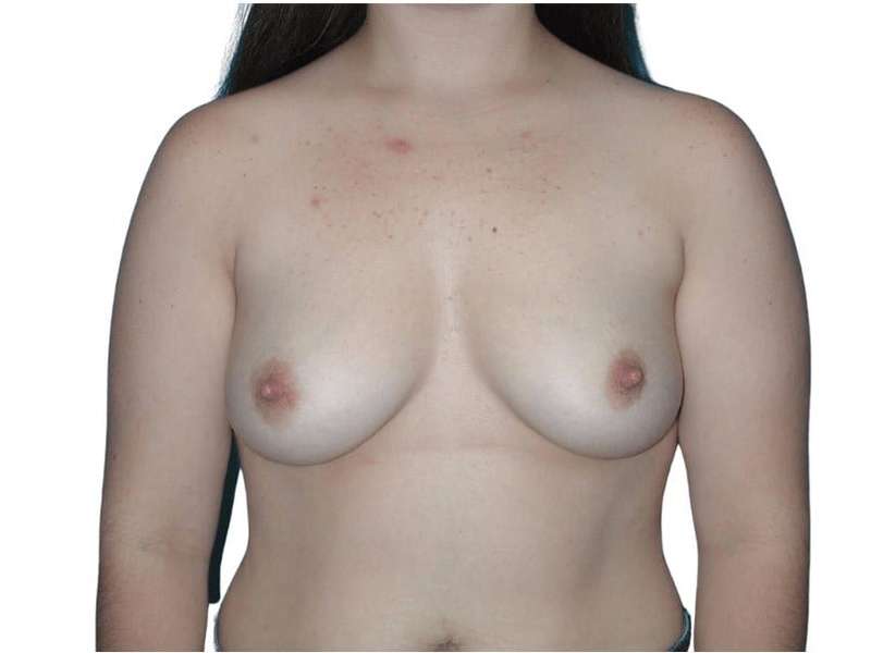 Breast Augmentation Before & After Patient #726