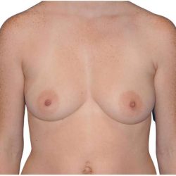 Breast Augmentation Before & After Patient #733