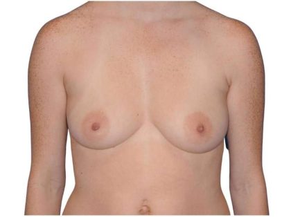 Breast Augmentation Before & After Patient #733