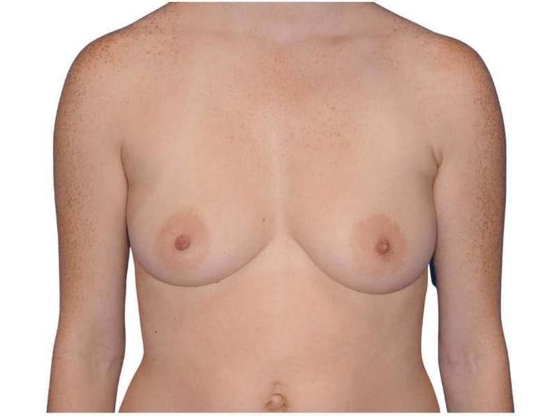 Breast Augmentation Before & After Patient #733