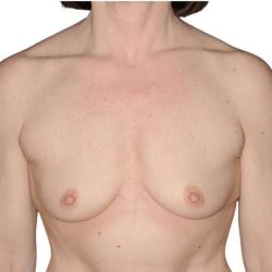 Breast Augmentation Before & After Patient #740
