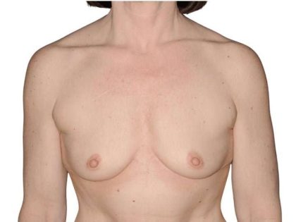 Breast Augmentation Before & After Patient #740
