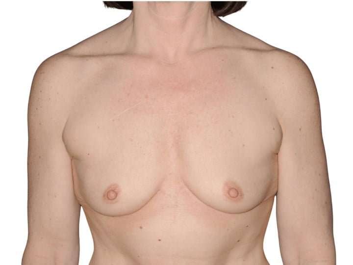 Breast Augmentation Before & After Patient #740