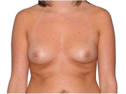 Breast Augmentation Before & After Patient #747