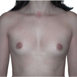 Breast Augmentation Before & After Patient #754