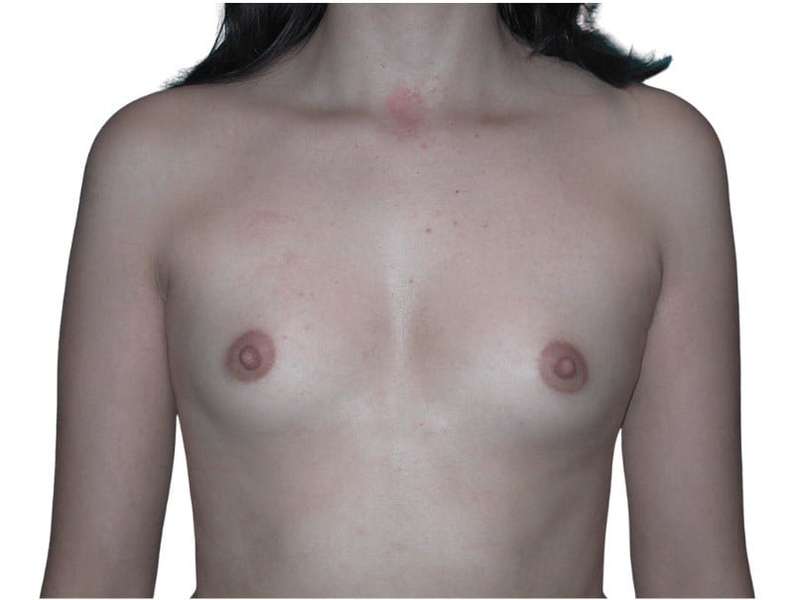 Breast Augmentation Before & After Patient #754