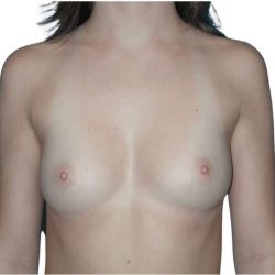 Breast Augmentation Before & After Patient #761