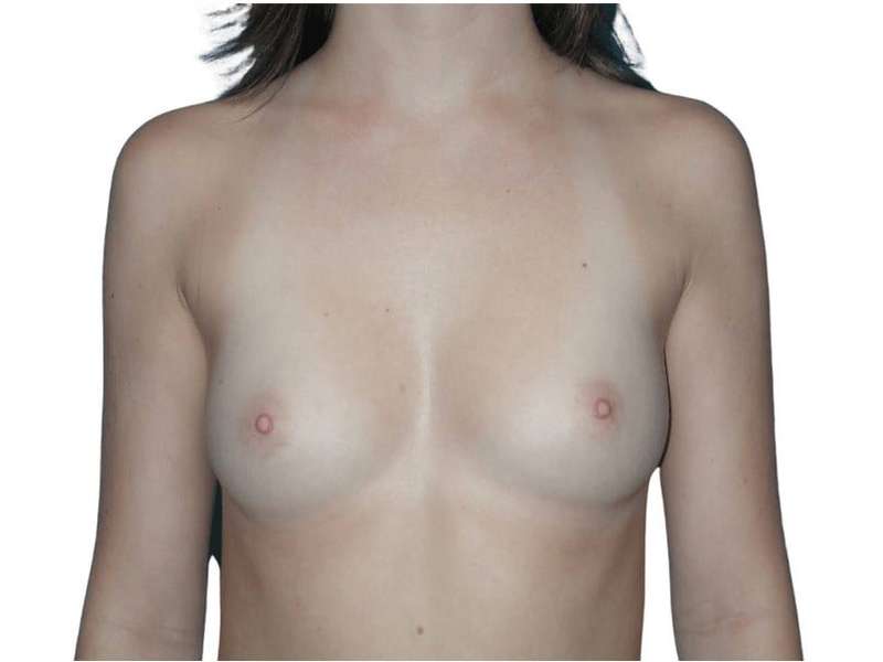 Breast Augmentation Before & After Patient #761