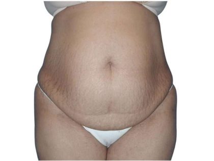 Tummy Tuck Before & After Patient #448