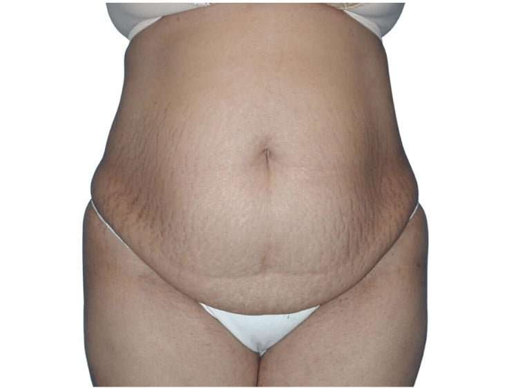 Tummy Tuck Before & After Patient #448
