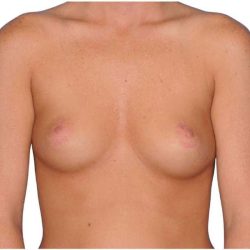 Breast Augmentation Before & After Patient #768