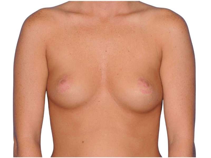 Breast Augmentation Before & After Patient #768