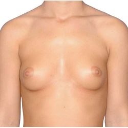 Breast Augmentation Before & After Patient #775