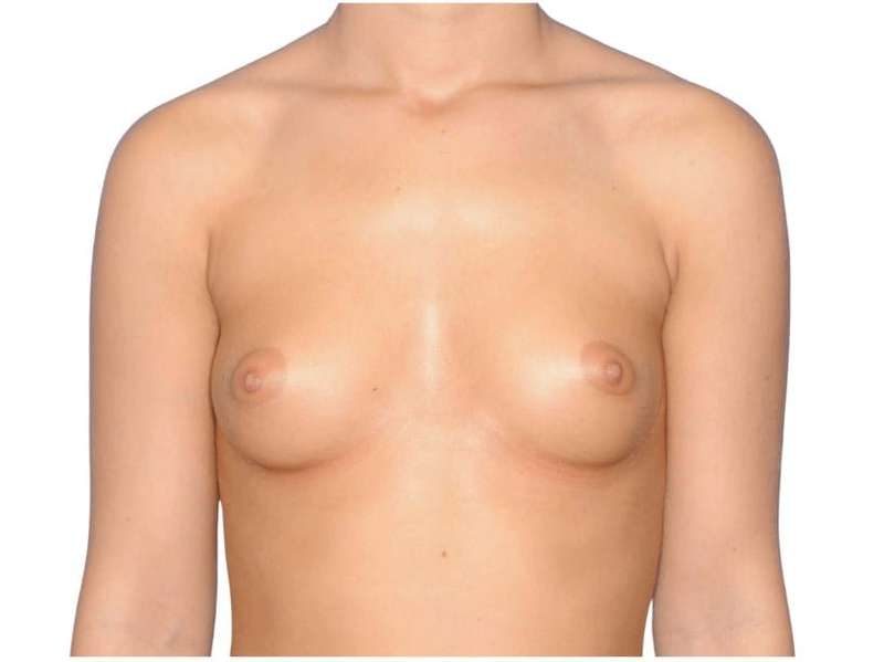 Breast Augmentation Before & After Patient #775