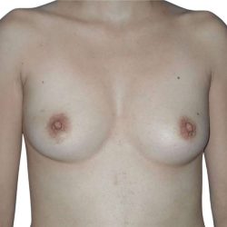 Breast Reconstruction Before & After Patient #782