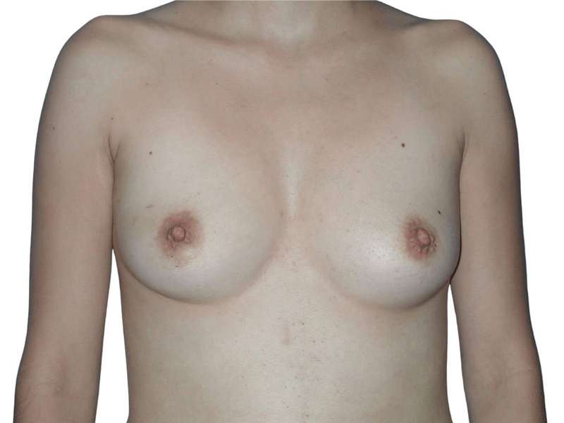 Breast Reconstruction Before & After Patient #782