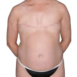 Breast Reconstruction Before & After Patient #805