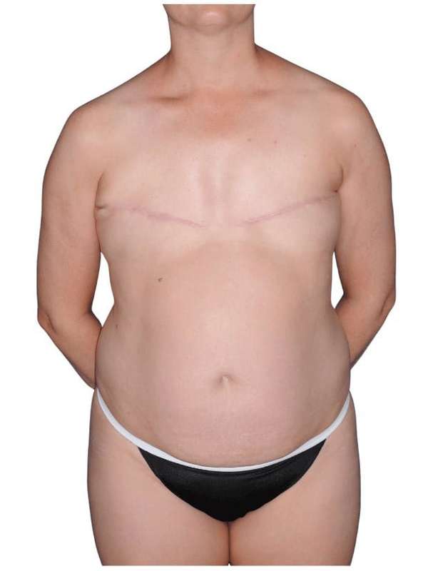 Breast Reconstruction Before & After Patient #805