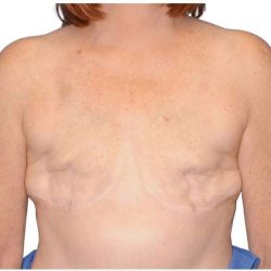 Breast Reconstruction Before & After Patient #810