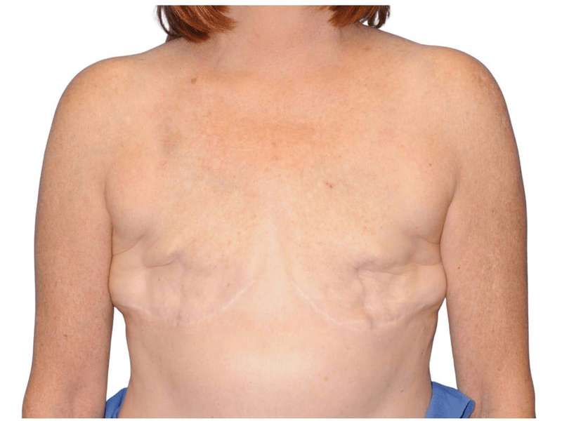 Breast Reconstruction Before & After Patient #810