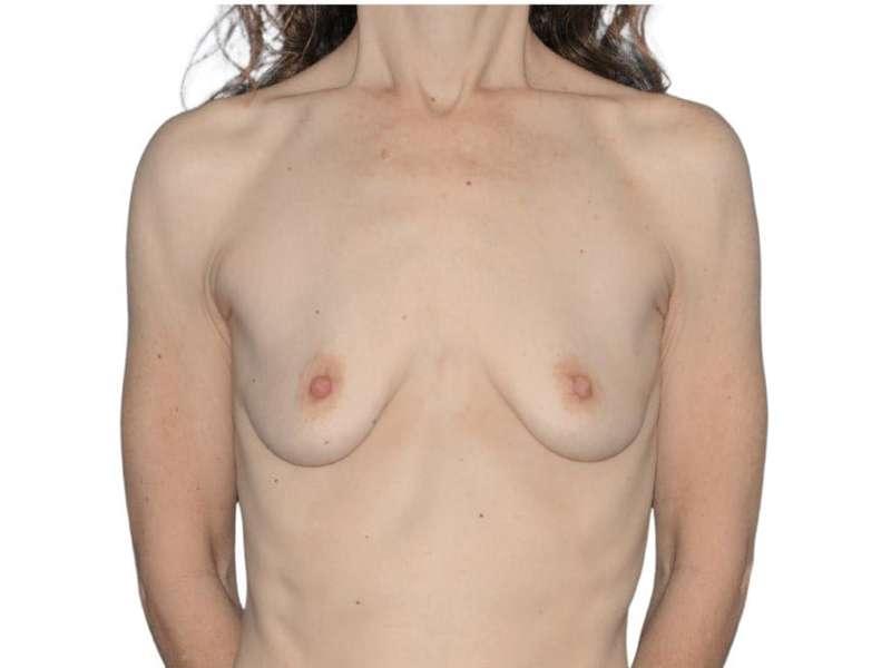 Breast Reconstruction Before & After Patient #821