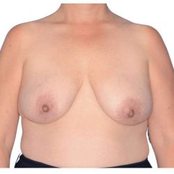 Breast Reconstruction Before & After Patient #828