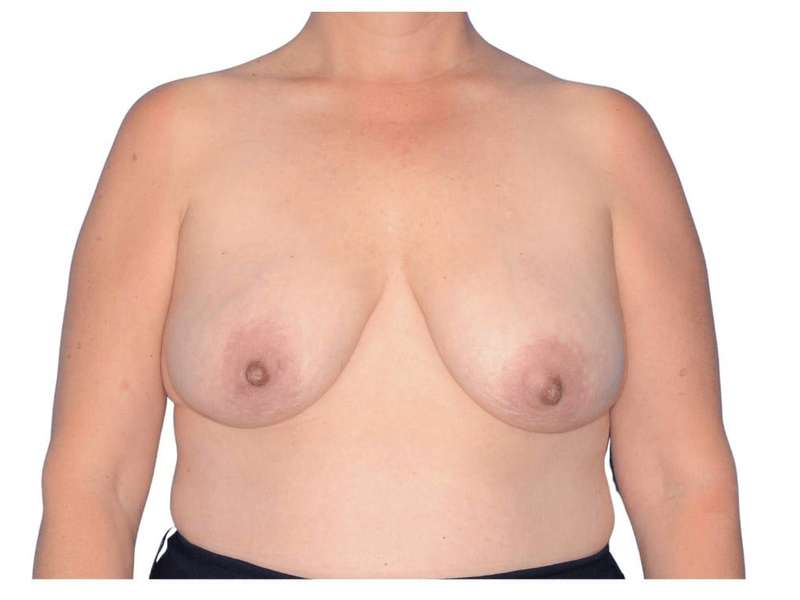 Breast Reconstruction Before & After Patient #828