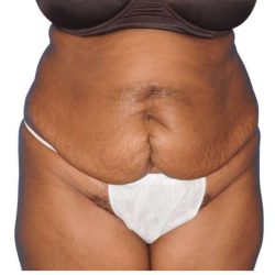 Tummy Tuck Before & After Patient #454