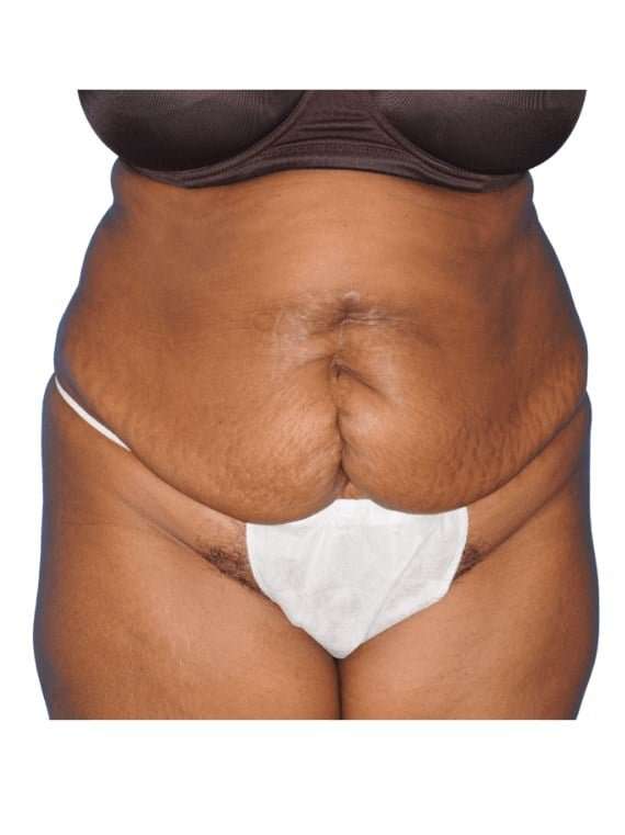 Tummy Tuck Before & After Patient #454