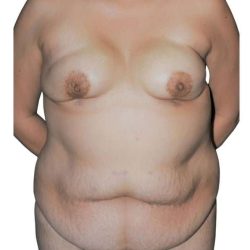 Breast Reconstruction Before & After Patient #873