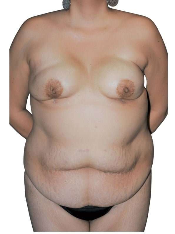 Breast Reconstruction Before & After Patient #873