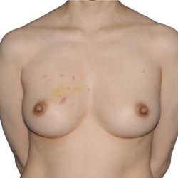 Breast Reconstruction Before & After Patient #880