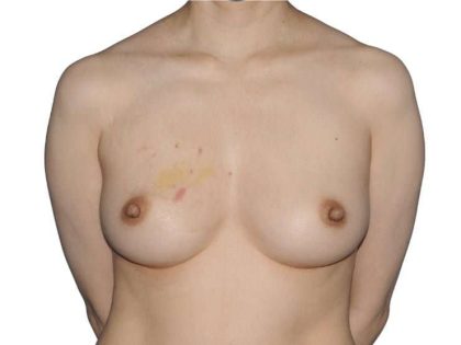 Breast Reconstruction Before & After Patient #880