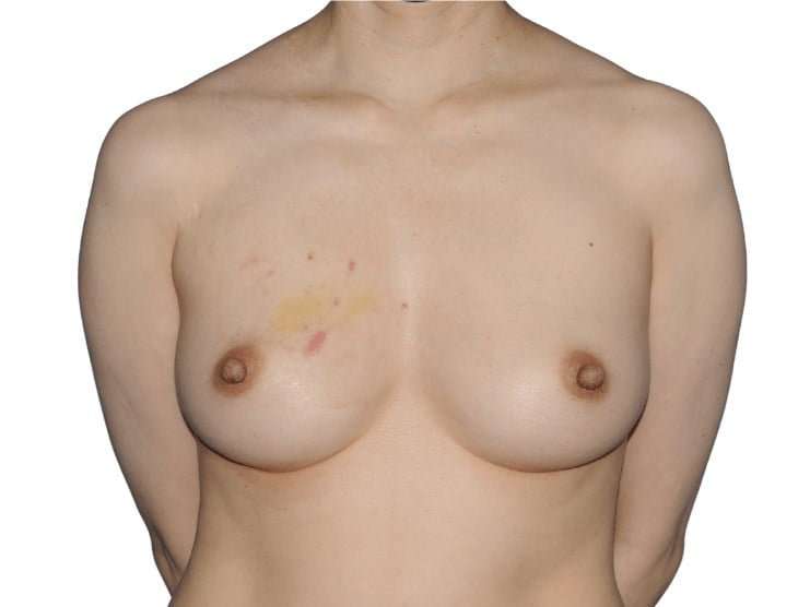 Breast Reconstruction Before & After Patient #880