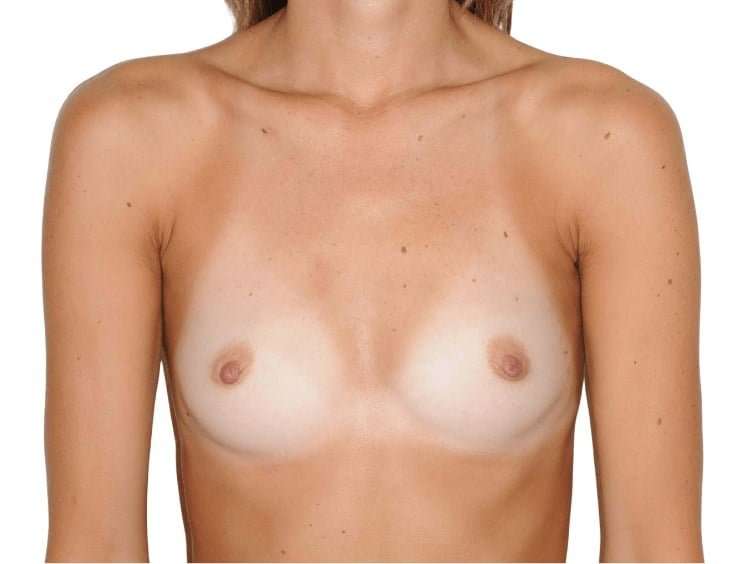 Breast Reconstruction Before & After Patient #912