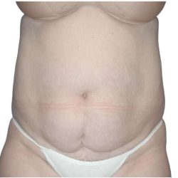 Tummy Tuck Before & After Patient #459