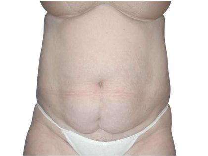 Tummy Tuck Before & After Patient #459