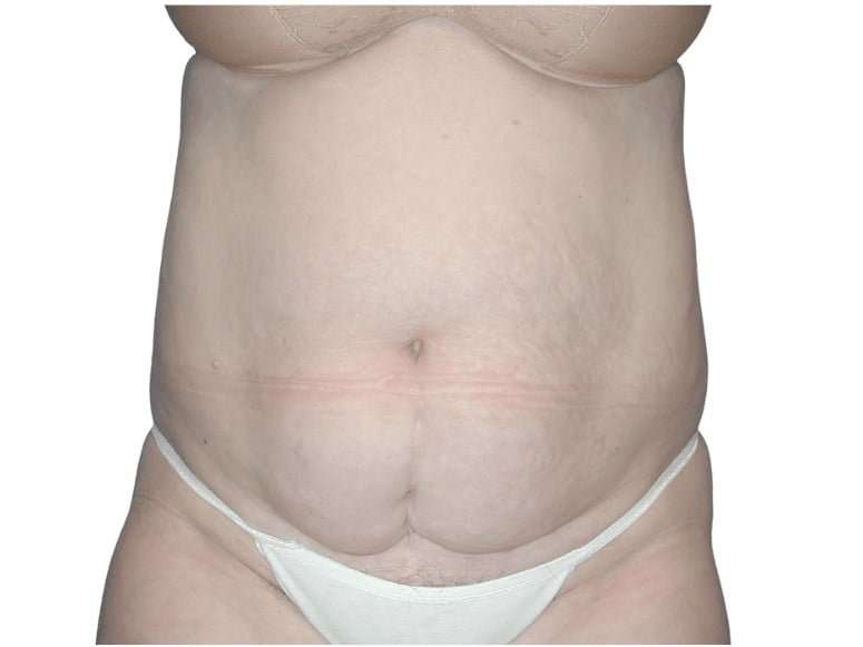 Tummy Tuck Before & After Patient #459