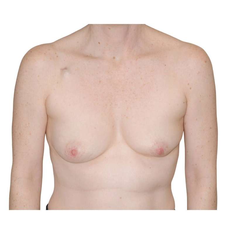 Breast Reconstruction Before & After Patient #930
