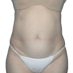 Tummy Tuck Before & After Patient #464