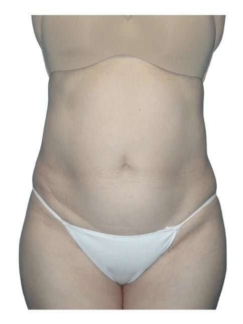 Tummy Tuck Before & After Patient #464