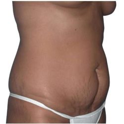 Tummy Tuck Before & After Patient #469