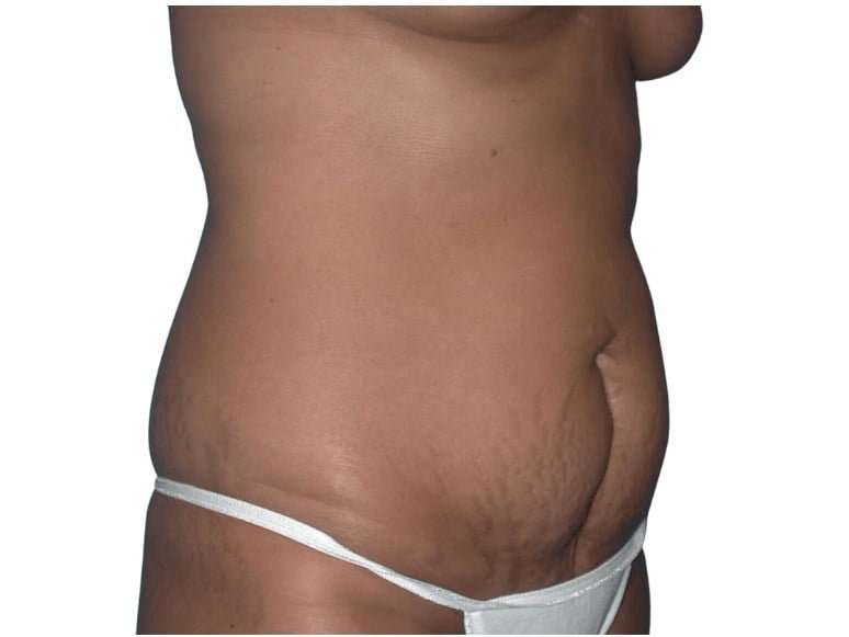 Tummy Tuck Before & After Patient #469