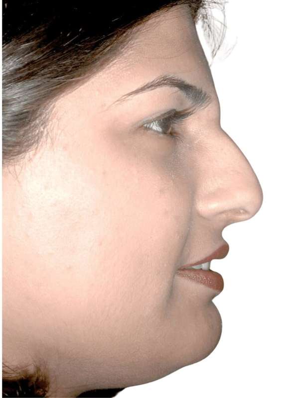 Rhinoplasty Before & After Patient #409