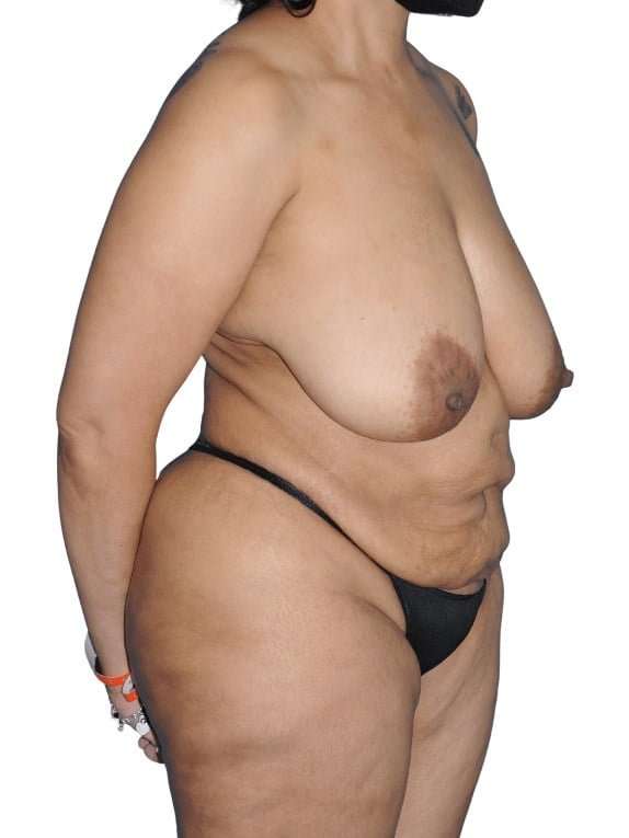 Mommy Makeover Before & After Patient #433