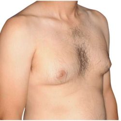 Gynecomastia Before & After Patient #515
