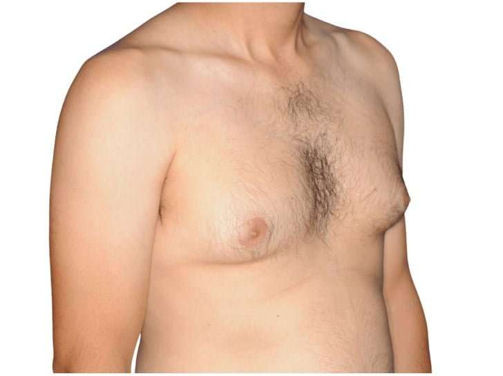 Gynecomastia Before & After Patient #515