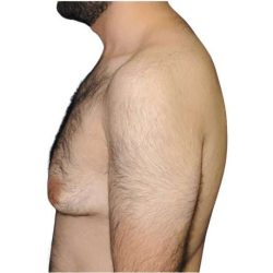 Gynecomastia Before & After Patient #525