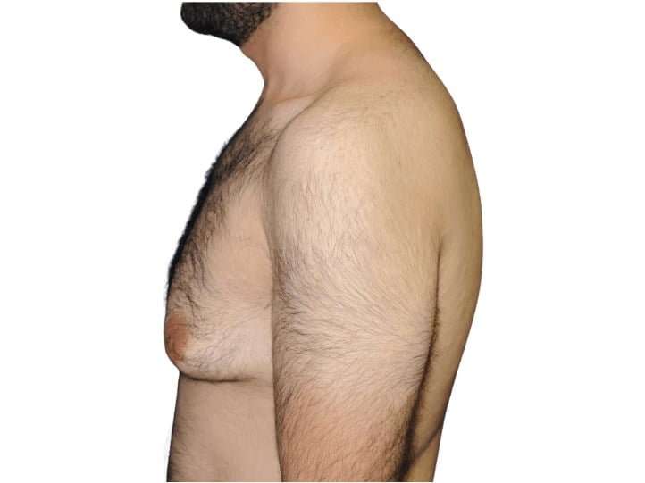 Gynecomastia Before & After Patient #525